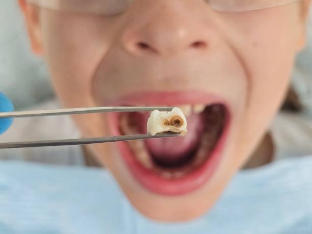 Best Emergency Dentist for Lost Fillings or Crowns in Olivehurst, CA